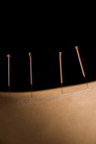 A photo of a back with acupuncture needles inserted.